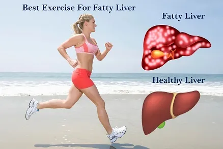 EXERCISE FOR FATTY & Unhealthy LIVER